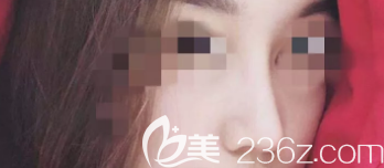 瞧瞧我在醫(yī)療美容門診部做的假體隆鼻+縮鼻翼手術(shù)，真的是實(shí)現(xiàn)了我想要的小翹鼻