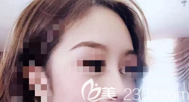 鼻綜合術(shù)后三個月側(cè)面照片 鼻綜合術(shù)后三個月側(cè)面照片