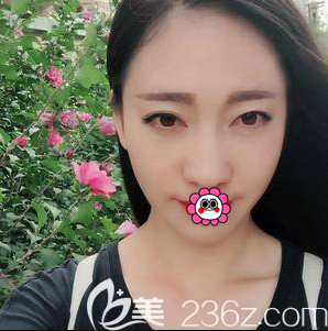 在北京潤(rùn)美玉之光做面部脂肪填充第40天效果