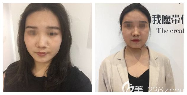 到南京藝星做面部吸脂術(shù)前 到南京藝星做面部吸脂術(shù)前