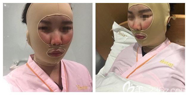 剛做完面部吸脂術(shù)后帶著頭套 剛做完面部吸脂術(shù)后帶著頭套