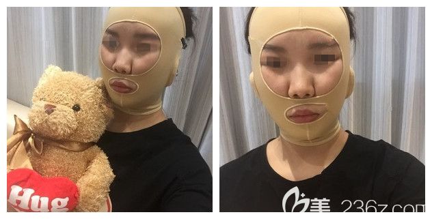 術(shù)后一周帶頭套恢復(fù)樣子 術(shù)后一周帶頭套恢復(fù)樣子