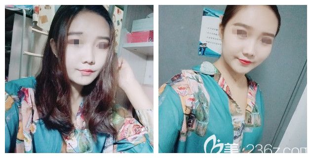 做面部吸脂術(shù)后半個(gè)月效果 做面部吸脂術(shù)后半個(gè)月效果