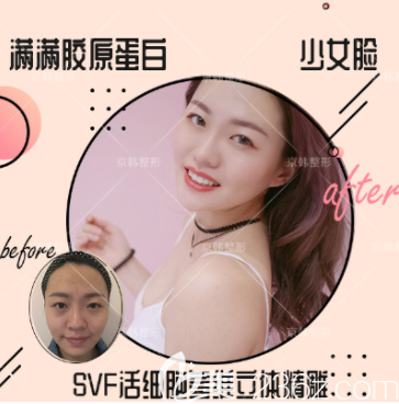 北京做臉部脂肪填充好的北京京韓喬愛軍醫(yī)生面部自體脂肪填充案例 北京做臉部脂肪填充好的北京京韓喬愛軍醫(yī)生面部自體脂肪填充案例
