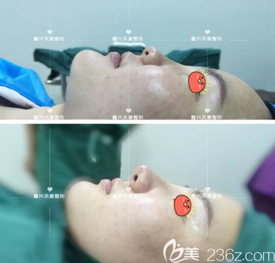 剛做完隆鼻手術(shù)效果對比圖片 剛做完隆鼻手術(shù)效果對比圖片