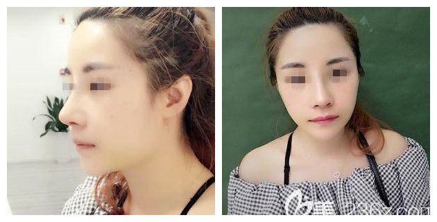 做完假體隆鼻術(shù)后五天鼻子恢復情況 做完假體隆鼻術(shù)后五天鼻子恢復情況