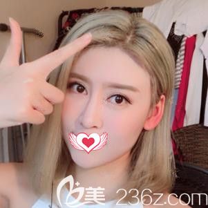 天宏整形醫(yī)生張學(xué)雷做埋線提升術(shù)后一周面部緊致飽滿