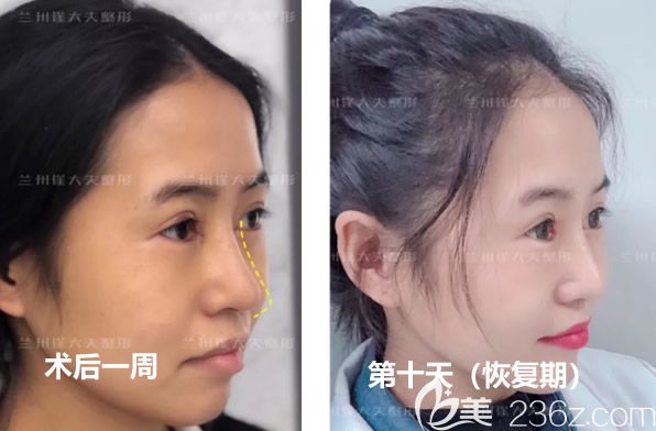 蘭州崔大夫徐隴豫切開雙眼皮第七天拆線后和第十天效果