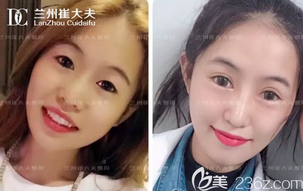 蘭州崔大夫割雙眼皮技術怎么樣 全切雙眼皮和鼻綜合隆鼻第10天效果值得一看