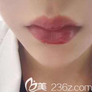 在石家莊天宏剛注射玻尿酸豐唇后唇部微腫 在石家莊天宏剛注射玻尿酸豐唇后唇部微腫