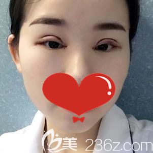項利姣院長幫我做切開雙眼皮術(shù)后即刻 項利姣院長幫我做切開雙眼皮術(shù)后即刻