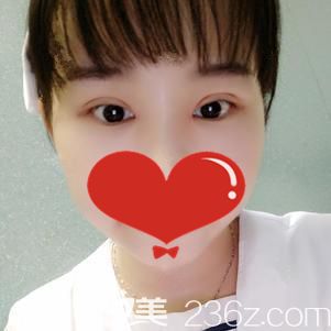 項院長做切開雙眼皮術(shù)后25天疤痕消失 項院長做切開雙眼皮術(shù)后25天疤痕消失