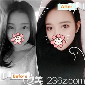 時光做眼綜合術(shù)后自然有神