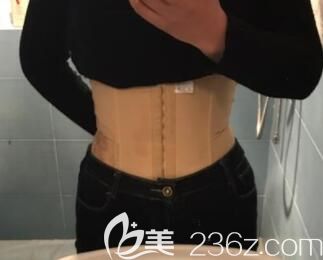 我在桂林華美整形做腰腹部環(huán)形吸脂第15天 我在桂林華美整形做腰腹部環(huán)形吸脂第15天