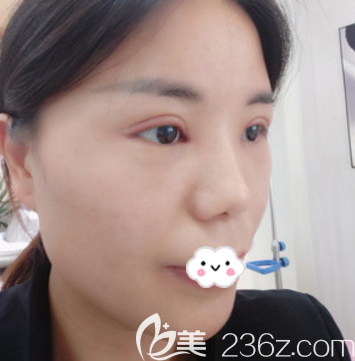 全切雙眼皮術(shù)后兩天效果圖