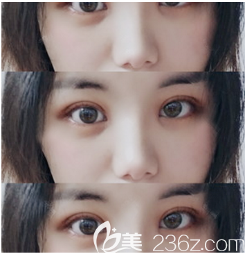 中山美南華全切雙眼皮7天拆線