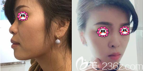 北京磨顴骨削下頜角案例 北京磨顴骨削下頜角案例