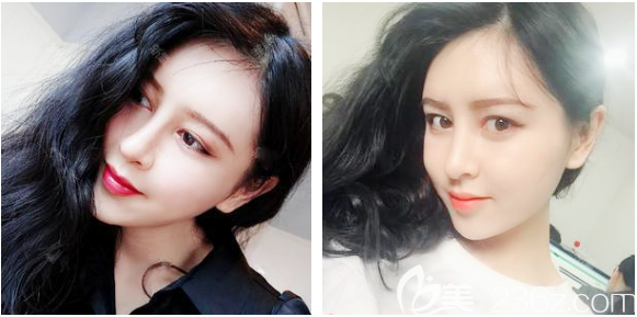 東莞脂肪填充哪家好？參考我找東莞壹加壹王擎院長(zhǎng)做的全臉脂肪填充恢復(fù)期照片吧