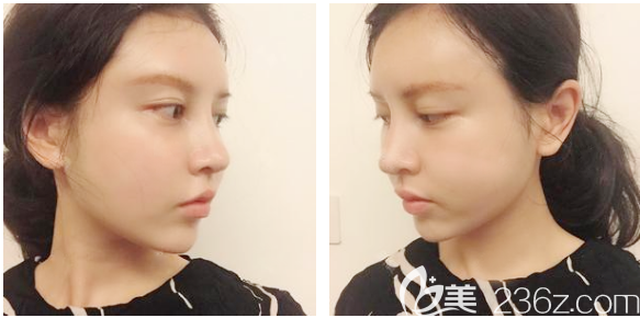 自體脂肪全臉填充術(shù)后兩天效果圖