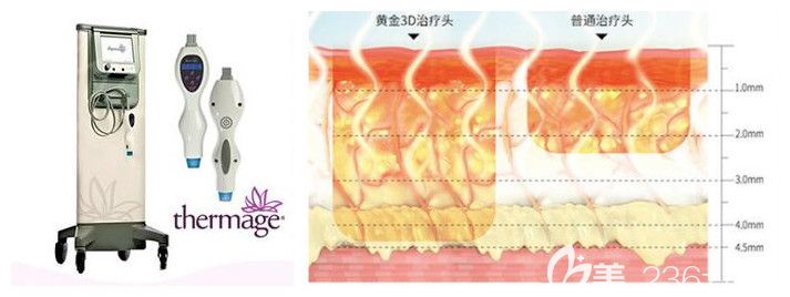 第四代塑美極儀器及原理