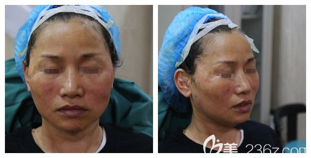 剛做完熱瑪吉第四代面部紅腫