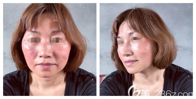 熱瑪吉術(shù)后第二天效果紅腫淡化