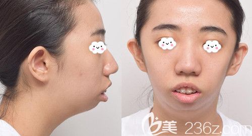 韓國(guó)EU頜面輪廓整形外科金鐘潤(rùn)上下顎突出矯正真人案例 韓國(guó)EU頜面輪廓整形外科金鐘潤(rùn)上下顎突出矯正真人案例