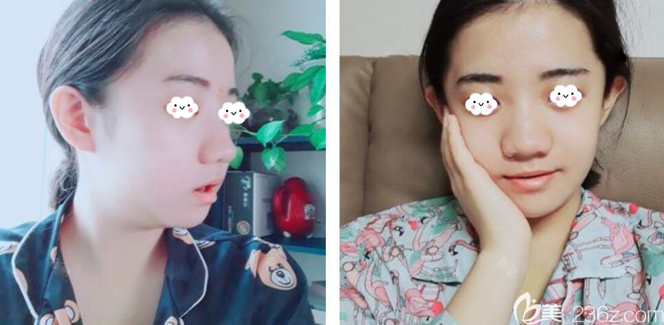 韓國(guó)EU頜面輪廓整形雙鄂手術(shù)術(shù)后7天恢復(fù)效果圖 韓國(guó)EU頜面輪廓整形雙鄂手術(shù)術(shù)后7天恢復(fù)效果圖