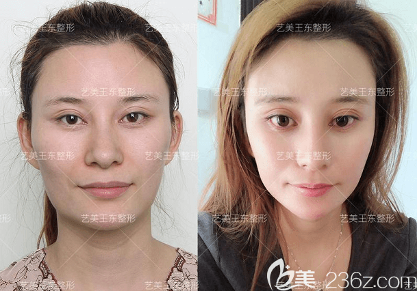 北京藝美王東醫(yī)生縮下頜角案例