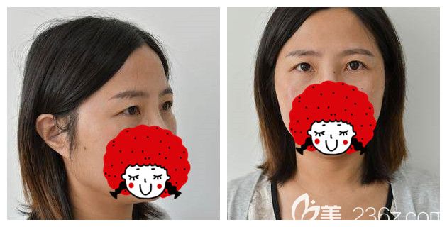 原本內(nèi)雙眼因皮膚松弛變單眼皮 原本內(nèi)雙眼因皮膚松弛變單眼皮