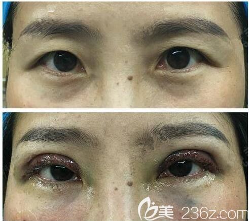 剛做完切開(kāi)雙眼皮+去皮術(shù)后眼部狀態(tài) 剛做完切開(kāi)雙眼皮+去皮術(shù)后眼部狀態(tài)