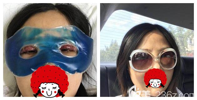 找孫影醫(yī)生做雙眼皮術(shù)后冰敷消腫 找孫影醫(yī)生做雙眼皮術(shù)后冰敷消腫