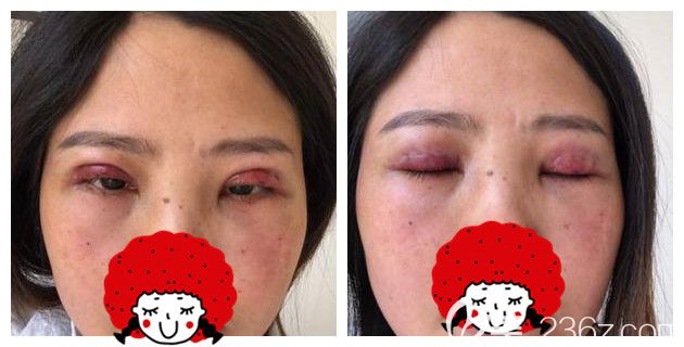 切開(kāi)雙眼皮第二天眼部腫脹明顯 切開(kāi)雙眼皮第二天眼部腫脹明顯