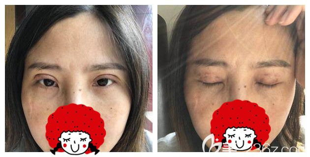 術(shù)后一周切開(kāi)雙眼皮+去皮術(shù)后恢復(fù)情況 術(shù)后一周切開(kāi)雙眼皮+去皮術(shù)后恢復(fù)情況