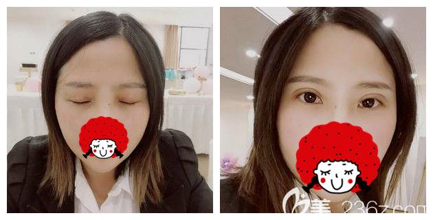 術(shù)后半個(gè)月切開(kāi)雙眼皮恢復(fù)中 術(shù)后半個(gè)月切開(kāi)雙眼皮恢復(fù)中