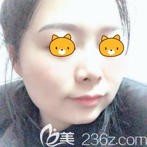 盛醫(yī)生幫我做激光祛斑術(shù)后7天斑點消失