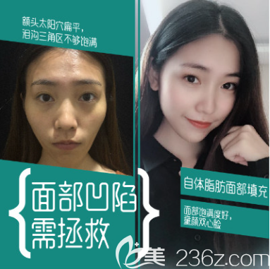 重慶好美整形豐太陽(yáng)穴案例