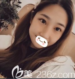 <!--<i data=20240703-sp></i>-->東醫(yī)生為我做眼綜合術(shù)后22天已經(jīng)消腫