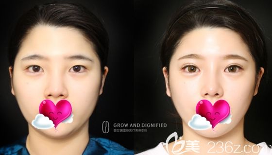 在長春姬安娣整形做面部自體脂肪填充前后效果對比圖 在長春姬安娣整形做面部自體脂肪填充前后效果對比圖