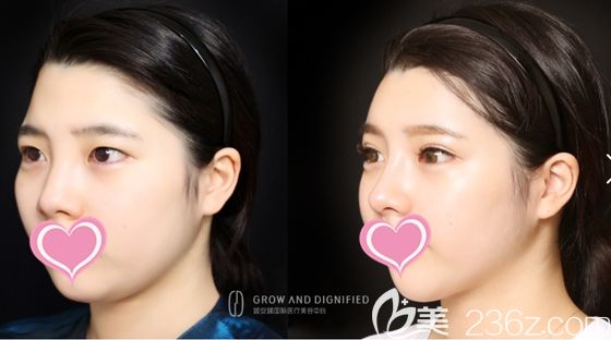 在長春姬安娣做鼻綜合隆鼻和切開雙眼前后效果圖 在長春姬安娣做鼻綜合隆鼻和切開雙眼前后效果圖