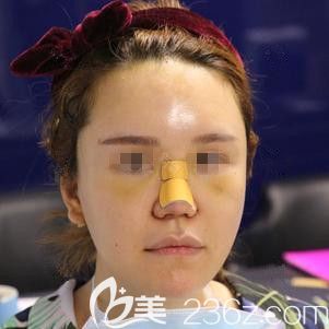 <!--<i data=20240703-sp></i>-->東醫(yī)生為我做脂肪填充和鼻綜合術(shù)后面部腫脹