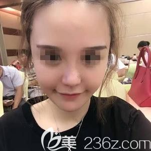 在張家口天宏做脂肪填充+鼻綜合術(shù)后10天慢慢恢復(fù)中