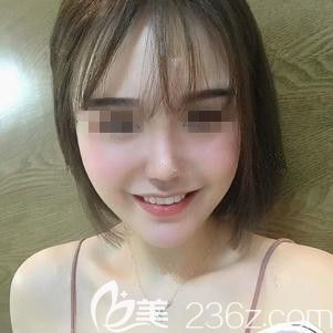 <!--<i data=20240703-sp></i>-->東醫(yī)生為我做脂肪填充和鼻綜合術(shù)后28天慢慢消腫