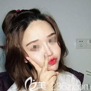 塌塌鼻+凹陷臉讓我土氣又顯老 經(jīng)過(guò)張家口天宏做鼻綜合整形+面部自體脂肪填充后蛻變氣質(zhì)女神