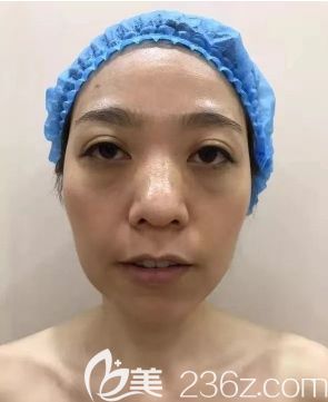 術(shù)前的我 術(shù)前的我