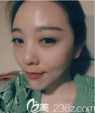 重慶好美整形自體脂肪全臉填充術(shù)后半個(gè)月 重慶好美整形自體脂肪全臉填充術(shù)后半個(gè)月
