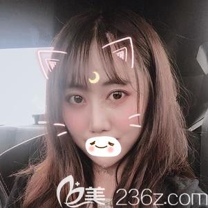 在石家莊天宏做脂肪填充術后20天慢慢消腫 在石家莊天宏做脂肪填充術后20天慢慢消腫