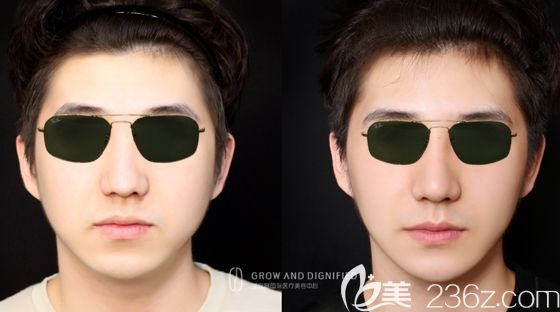 長春姬安娣整形面部輪廓整形前后對比圖 長春姬安娣整形面部輪廓整形前后對比圖