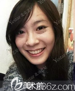 我在北京藝星祛眼袋前樣子 我在北京藝星祛眼袋前樣子