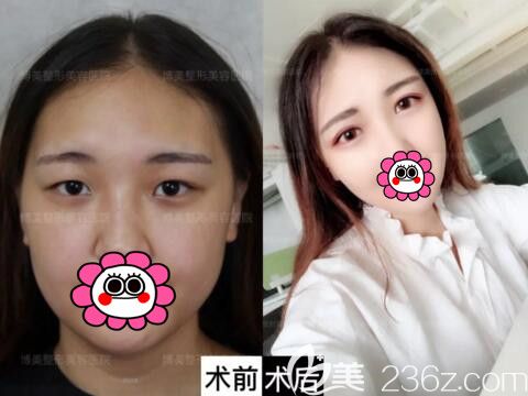 永州博美整形美容醫(yī)院雙眼皮整形真人前后對(duì)比照